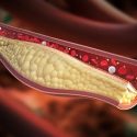 横截面图的胆固醇在动脉周围血细胞流动
